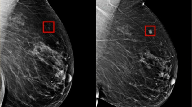 AI cancer detection reaches unprecedented levels of 99% accuracy 321321132