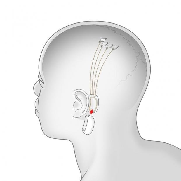 Elon Musk's Neuralink head DRILLING tests begin next year