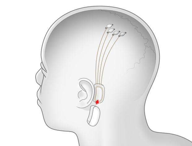 Elon Musk says when he'll reveal the Neuralink progress update 02
